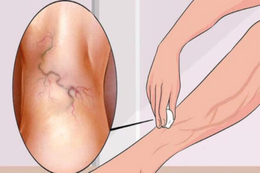 أفضل الأدوية والإجراءات.. اكتشف طرق علاج الدوالي الطبية